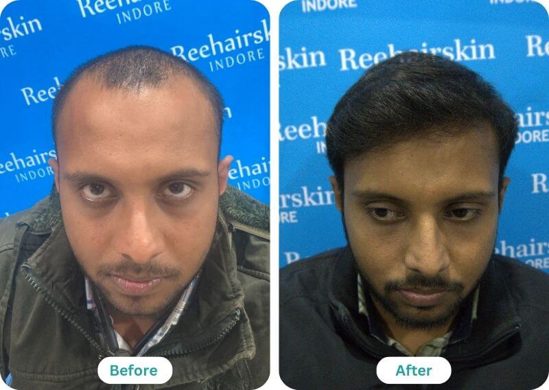 Hair Transplant Result Before And After